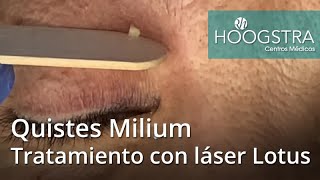 Quistes Milium  Tratamiento con láser Lotus 20219 [upl. by Pump]