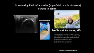 Ultrasound guided infrapatellar superficial or subcutaneous bursitis injection [upl. by Sheelagh]