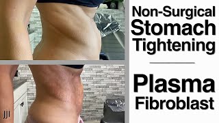 Non Surgical Stomach Tightening  Plasma Fibroblast [upl. by Squire]