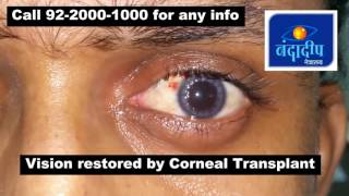 Corneal transplant result DALK [upl. by Kat970]