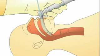 Tracheal Intubation Procedure  Nursing CE [upl. by Willyt872]