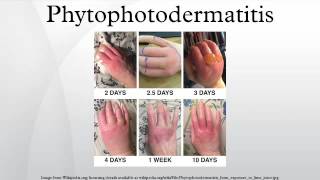 Phytophotodermatitis [upl. by Virgie946]