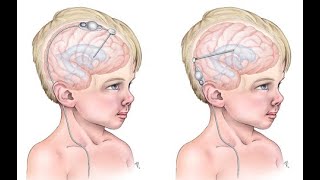 HIDROCEFALIA  CASO CLÍNICO  Fisiopatología  Síntomas  Diagnóstico  Tratamiento en 6 MINS [upl. by Richella522]