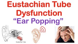 Eustachian Tube Dysfunction “Popping Sound in Ears”  Causes Symptoms Diagnosis Treatment [upl. by Nnayllek895]