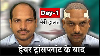 Day 01 After Hair Transplant  Best Hair Transplant in India [upl. by Amandy]