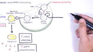 ANCA Associated Vasculitis AntiNeutrophil Cytoplasmic Antibody  Causes Pathophysiology Types [upl. by Nahtnaoj949]