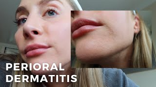 Perioral Dermatitis What to Know Skincare  An Estheticians Experience [upl. by Araldo]