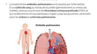 L embolie pulmonaire [upl. by Egas]