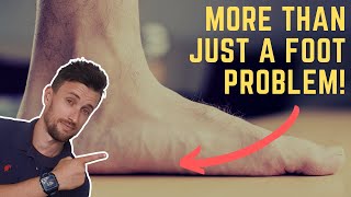 Why Flat Feet Are More Than Just a Foot Problem [upl. by Gui]