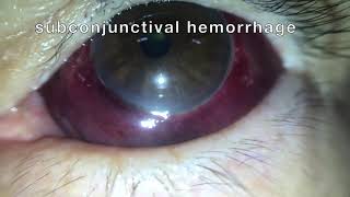 Subconjunctival hemorrhage hyposphagma [upl. by Robin152]