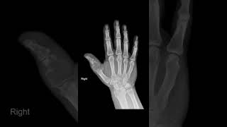 X ray HandMultiple myeloma  thumb shortsfeed [upl. by Sessylu]