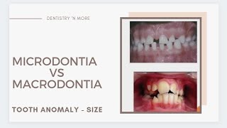 DEVELOPMENTAL DISTURBANCES OF TEETH  PART 1SIZE [upl. by Coady275]