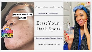 Is hyperpigmentation ruining your life [upl. by Nwahsud]