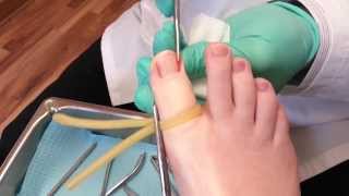 Ingrown toenail surgery [upl. by Sarina]