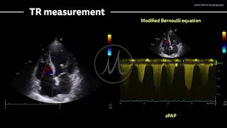 〖Echocardiography〗 Tricuspid regurgitation amp sPAP [upl. by Sekyere]