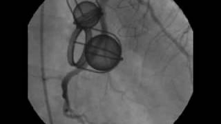 Two Views of the StarrEdwards Valves during Cardiac Catheterization [upl. by Middle]