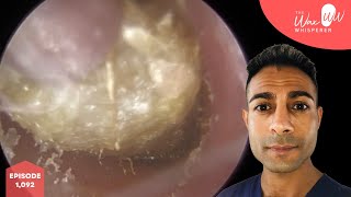 1092  Fully Blocked Ear Wax amp Dead Skin Removal [upl. by Einwahr321]