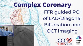 FFR guided PCI of LADDiagonal Bifurcation and OCT imaging  CCC Live April 2016 [upl. by Sabsay]