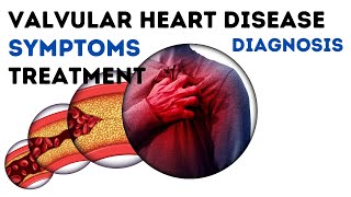 Valvular heart disease  symptoms causes treatment [upl. by Akehsay]