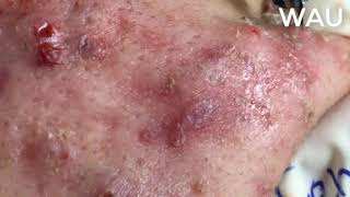 Squeeze acne  acne hidden under the skin  part 5 [upl. by Sulohcin]