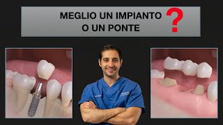 Meglio un ponte o un impianto dentale [upl. by Lamont]