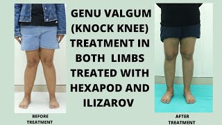 Adult Genu ValgumTreatment with Ilizarov and Hexapod  Dynamic Correction with Functional Feedback [upl. by Selrahc]