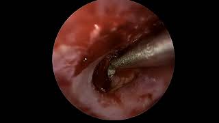 Ear drum repair tympanoplasty with lateral graft [upl. by Ronnie]