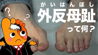 【こうなってたら注意】あなたも外反母趾かも！？【巻き爪先生 Vol18 】by Pincer Nails treatment Center®︎ [upl. by Edelstein]