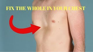 how to get rid of pectus excavatum without surgery [upl. by Venuti]