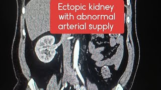 Ectopic kidney with abnormal arterial supply ctscan radiology learningradiology case facts [upl. by Binky]