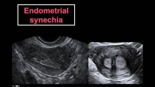 Ultrasound Based Complete Evaluation of the Infertile Patient in a Single Visit [upl. by Rossner]