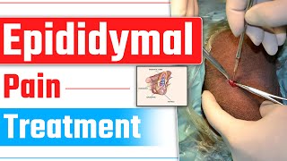 Varicocele or Epididymal Cyst  Epididymal Pain Treatment  Dr Health [upl. by Yr593]