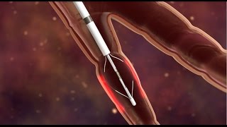 Bronchial Thermoplasty for Asthma [upl. by Avilo]