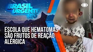 Mãe encontra hematomas em filha pequena ao voltar da escola [upl. by Milli]