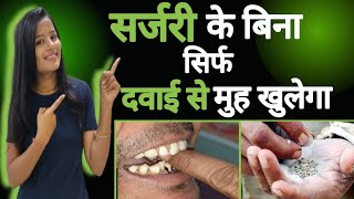 Surgery Ke Bina Sirf Davaiyo Se Muh khulega  Treatment for Oral Submucosa Fibrosis  OSMF [upl. by Tjader]