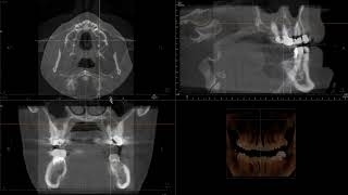 Periapical Cyst Pseudocyst Mucocele [upl. by Celik704]