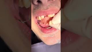 Temporary way of replacing a missing front tooth with a flipper🐬🦷 shorts viral teeth tiktok [upl. by Htebsil25]