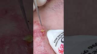 P001  SacDepSpa acne pimple sacdepspa blackheads [upl. by Lawrence565]