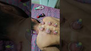 Cupping therapy for upper back stiffnesscuppingtherapy cupping physiotherapist shoulder [upl. by Arhas]