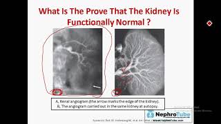 Hepatorenal Syndrome English Language  Dr Gawad [upl. by Attenra]