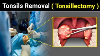 Tonsillectomy Procedure  How Tonsils Remove  Tonsils  Tonsillitis  3D ANIMATION UrduHindi [upl. by Vachel]