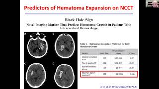 Neurología  Intracerebral hemorrhage management update [upl. by Nimocks77]