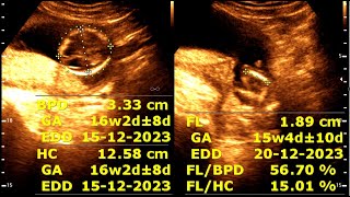 16 weeks 2 days pregnancy  Normal pregnancy [upl. by Michael]