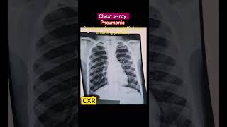 medical doctors chest xray pneumonia radiology youtubeshorts nursing [upl. by Gilroy]