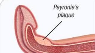 Peyronies Disease Symptoms Causes Treatment Surgery [upl. by Joyann703]