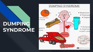 DUMPING SYNDROME [upl. by Musa236]