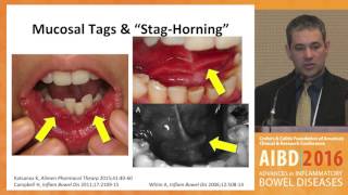 Extraintestinal Manifestations in Pediatric IBD Orofacial granulomatosis [upl. by Nwahsak]