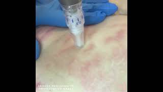 Skinpen Microneedling Procedure To Treat Stretch Marks [upl. by Meenen778]