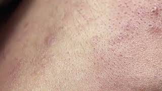 Acne on skin  Remove nose pimples  Acne Treatments Mai Ngoc 💕💕💕 [upl. by Leile754]