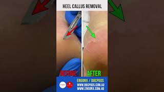 Heel Callus Removal [upl. by Anaeel]